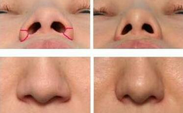 哪些人適合做鼻孔縮??？一般會(huì)用什么方法來(lái)達(dá)到縮小鼻孔的目的