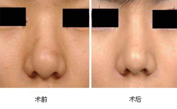 縮小鼻頭有什么辦法?為什么說(shuō)一定要選擇正規(guī)醫(yī)院醫(yī)生做手術(shù)