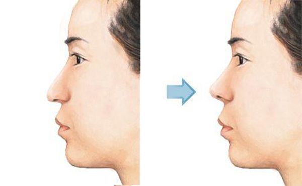 箭鼻矯正術(shù)是什么?術(shù)前術(shù)后都有哪些注意事項(xiàng)