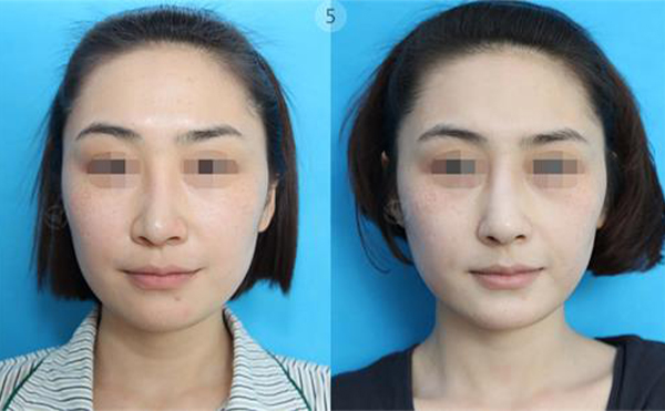 做歪鼻矯正手術(shù)大概需要多少錢?受哪些方面影響?