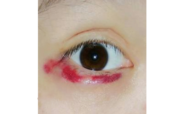 自體脂肪豐臥蠶有風險嗎?術后怎么護理?