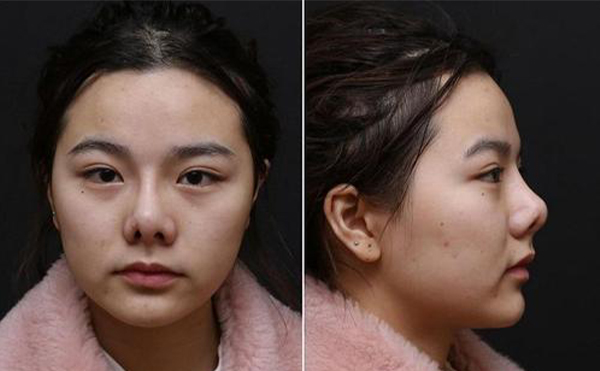 隆鼻是不是都需要做修復(fù)?