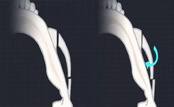 顴骨內(nèi)推是什么？