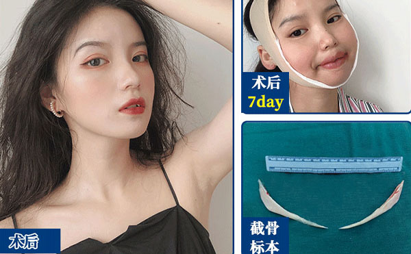 磨骨整形術(shù)后注意事項