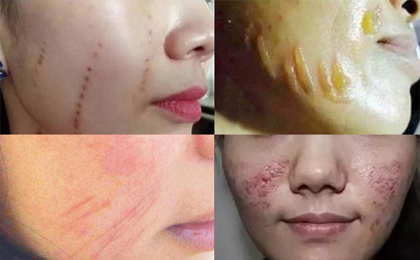 超聲刀有副作用嗎？