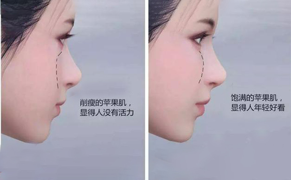 蘋果肌凹陷怎么辦？