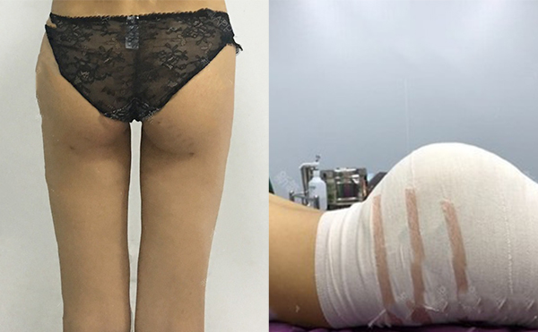 做假體豐臀有沒(méi)有年齡限制?哪些人不適合做假體豐臀?