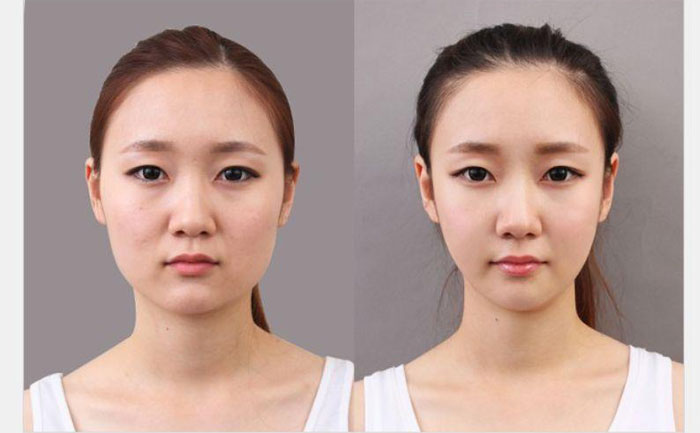 非手術(shù)瘦臉多少錢(qián)？非手術(shù)瘦臉?lè)椒ㄓ心男? data-mce-src=