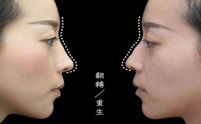 駝峰鼻矯正手術多少錢？駝峰鼻怎么改善？