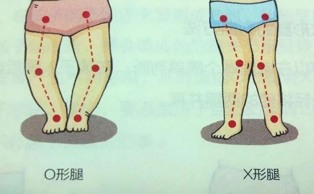 羅圈腿怎樣矯正？羅圈腿手術(shù)矯正多少錢？