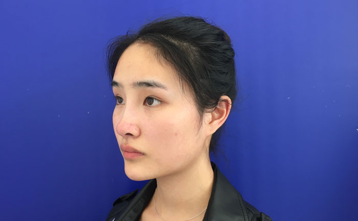 墊下巴一般多少錢？