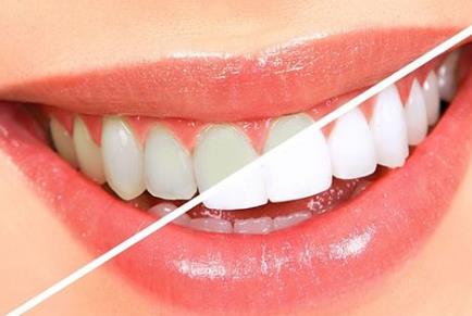 做牙冠多少錢一顆？