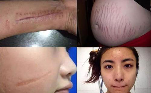 疤痕修復(fù)手術(shù)一般多少錢？