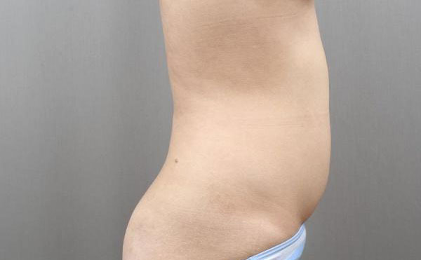 腹部吸脂手術(shù)價(jià)格是多少？腹部吸脂手術(shù)的副作用？