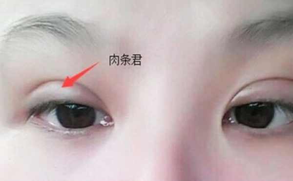 雙眼皮不自然怎么補救？雙眼皮肉條好修復(fù)么？