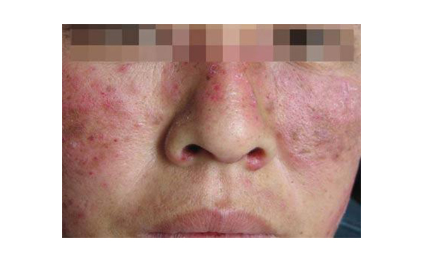 復(fù)合彩光會(huì)出現(xiàn)副作用嗎？