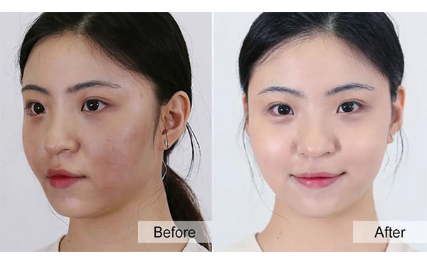 美白針有什么優(yōu)勢？