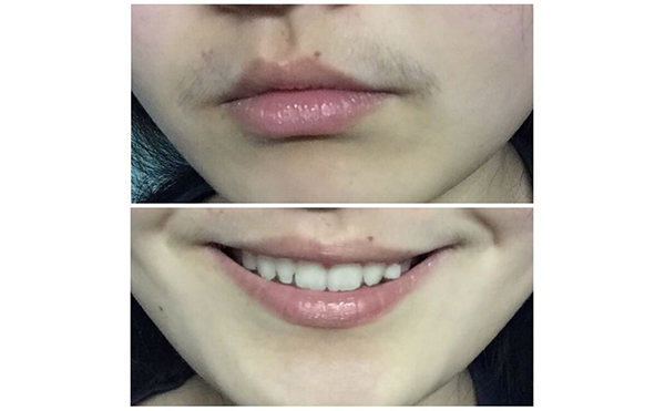 冰點面部脫毛會影響毛孔嗎?