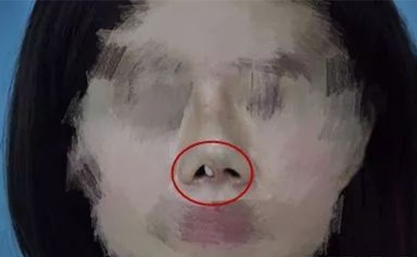 隆鼻假體取出后怎么做可以盡快恢復(fù)原樣?