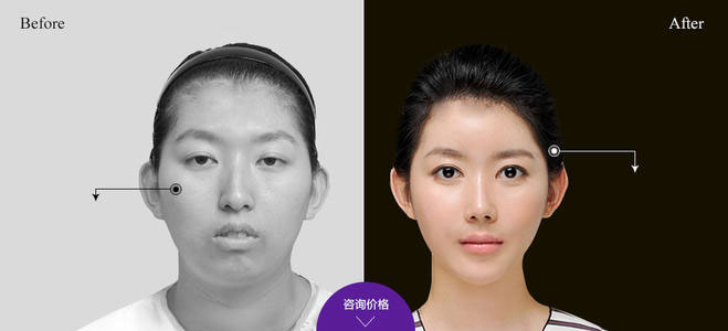 下頜角整形的方法有哪些？