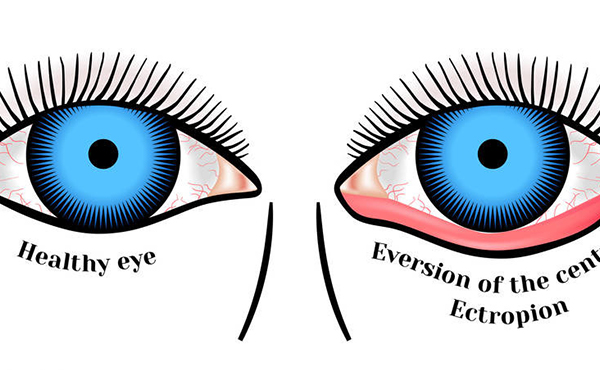 去眼袋安全嗎?去眼袋失敗怎么修復?
