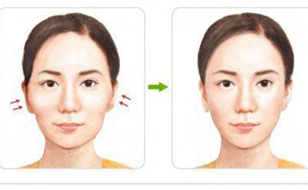 顴骨整形術(shù)后相關(guān)的護(hù)理工作有哪些?