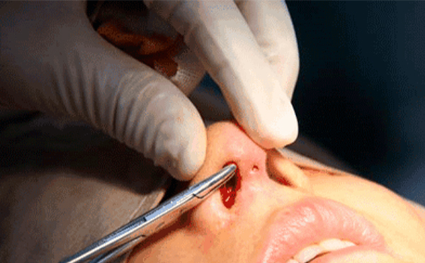 在原來的假體上，可不可以重新調(diào)整或者更換一下?