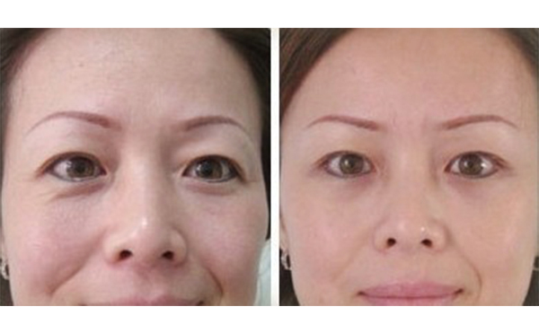 做眼袋可以去皺紋嗎?手術(shù)后周?chē)つw青紫怎么辦?