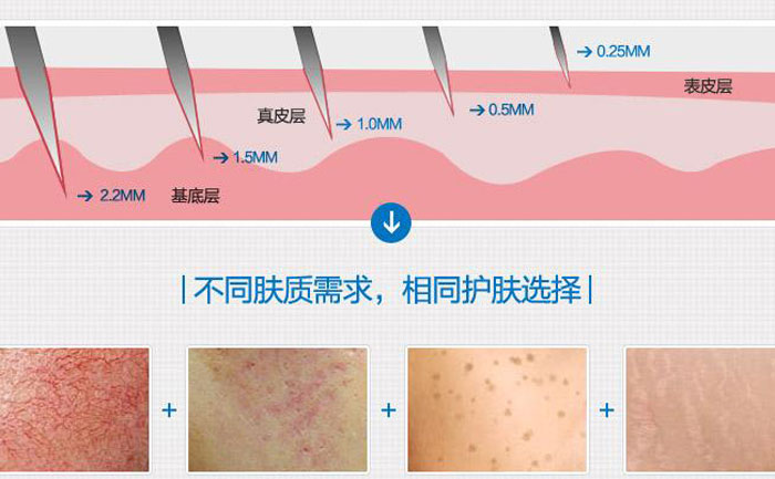 微針去痘坑多少錢一次？