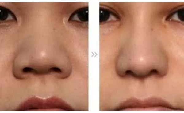 做鼻頭縮小手術(shù)有什么要求?