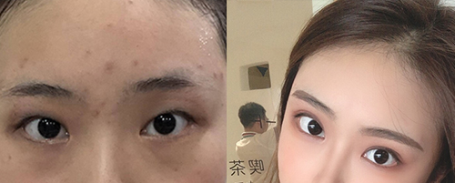 蘭州亞韓做雙眼皮案例對(duì)比圖2