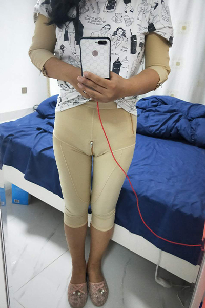 大腿環(huán)吸術(shù)恢復(fù)期