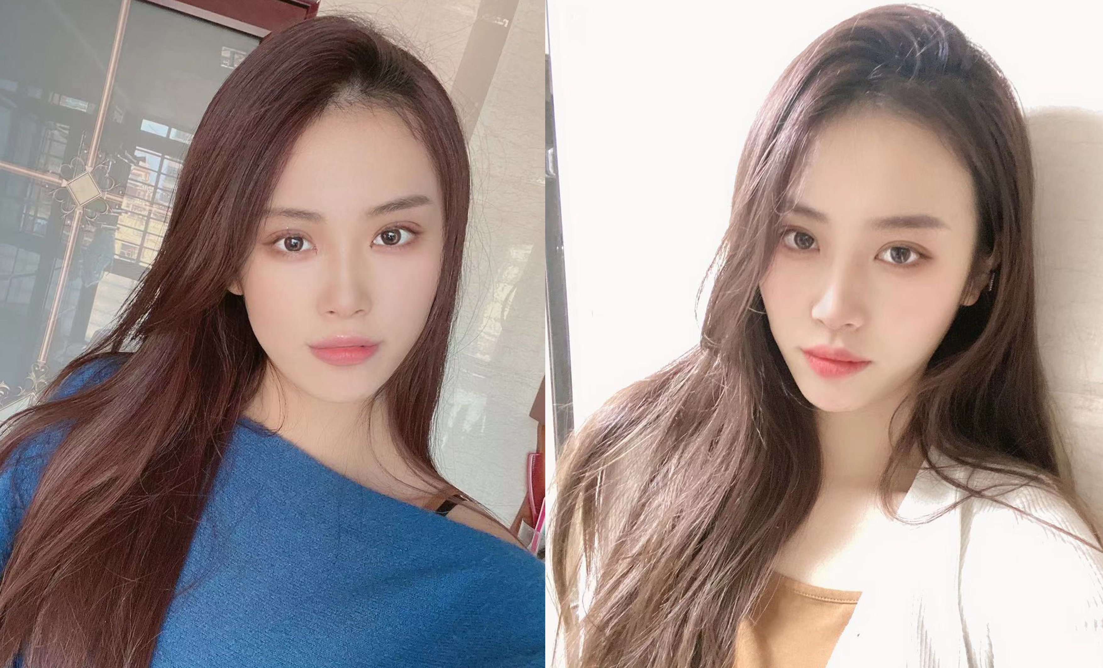 寧波藝星熱瑪吉術(shù)后一年效果反饋3