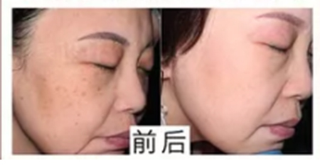 華韓醫(yī)療美容醫(yī)院祛斑案例對(duì)比2