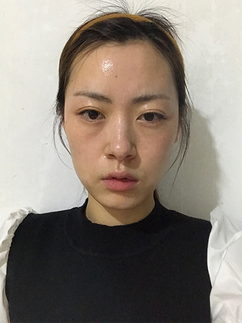 天津伊美爾超肋鼻綜合案例大賞