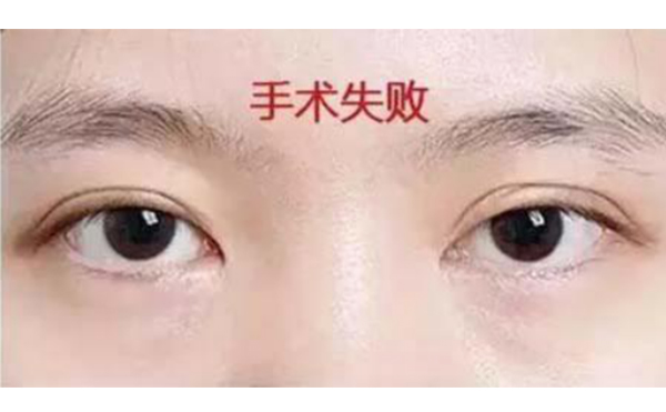 韓式三點雙眼皮的優(yōu)點是什么?術(shù)后怎么避免不對稱?