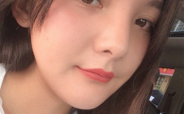 石家莊藍(lán)山杜建龍醫(yī)生下頜角整容手術(shù)案例術(shù)后三個(gè)月