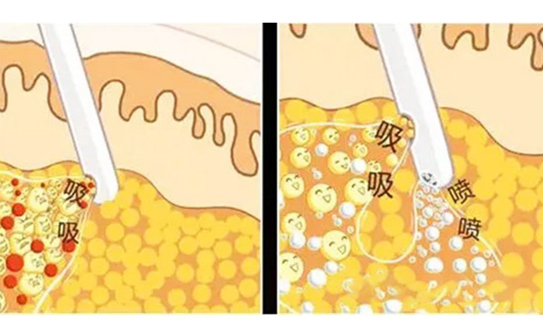 什么是水動力吸脂？