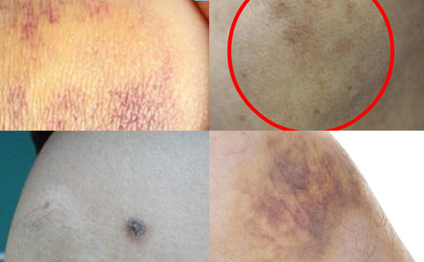 背部吸脂后遺癥是什么?術(shù)后如何護(hù)理?