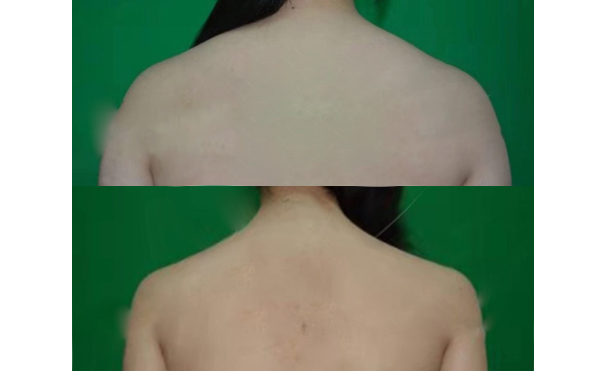 背部吸脂手術(shù)前要注意什么？