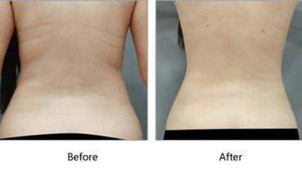 吸脂瘦背部多少錢？