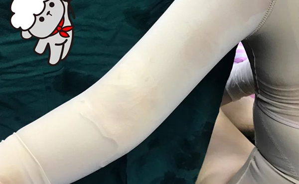 超聲波吸脂瘦手臂安全嗎？