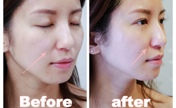 電波拉皮是什么原理？