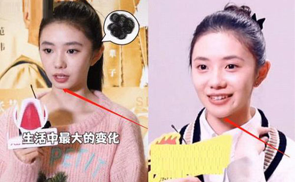 玻尿酸隆下巴整形攻略【優(yōu)勢、適宜人群、注意事項】