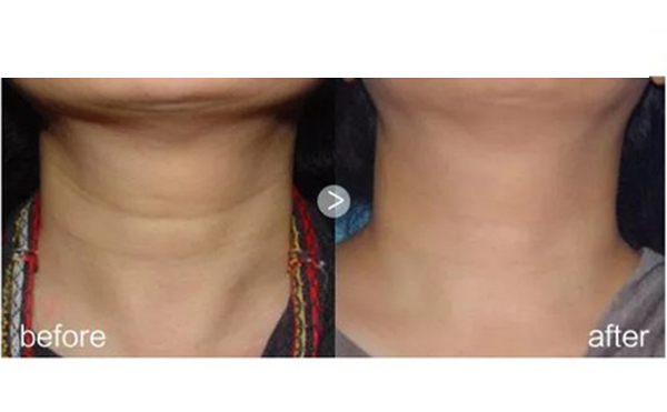 哪些人不能做嗨體？