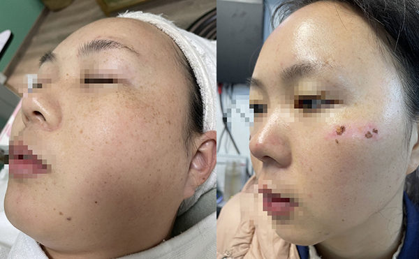 彩光嫩膚有沒有副作用？