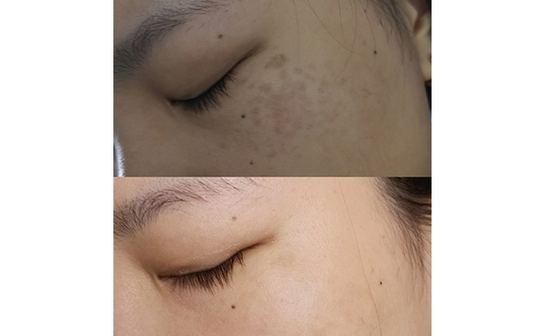 激光美白能維持多久？