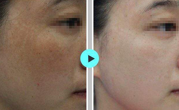 激光祛斑會(huì)使皮膚變薄嗎？