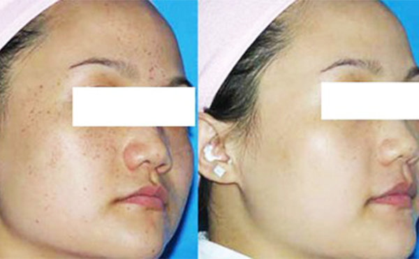 激光祛斑治療一次要多久？