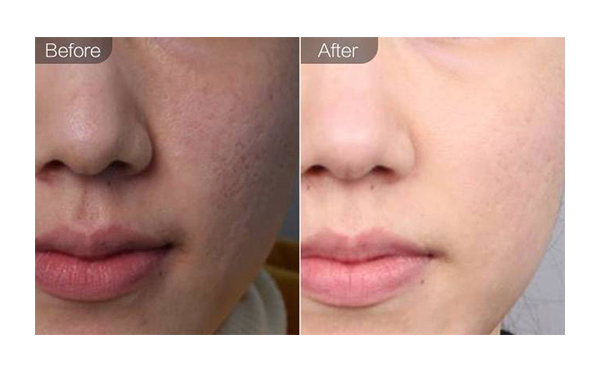 e光嫩膚適合哪些人？